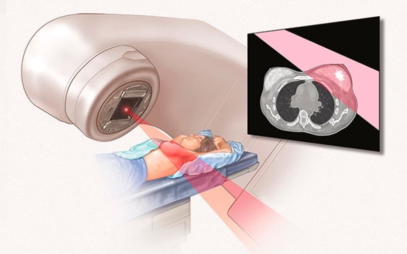 Breast Cancer Radiation
