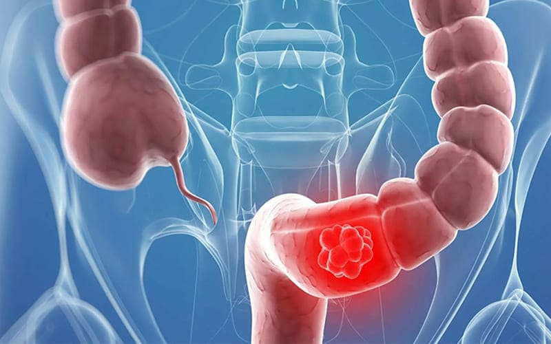 gastrointestinal-cancer