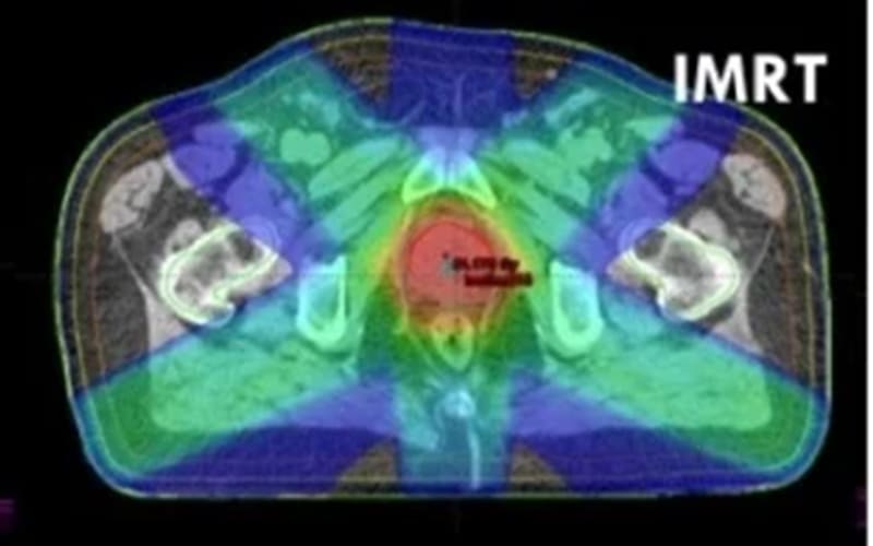 imrt